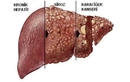Karaciğer Hastalıkları Belirtileri Nelerdir?