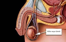 Varikosel Belirtileri Nelerdir?